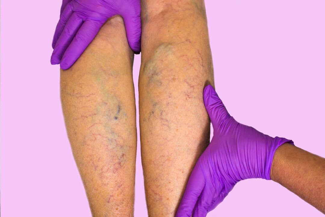 Varicose veins in legs