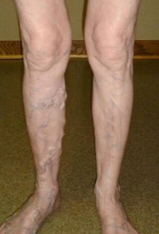 Varicose veins