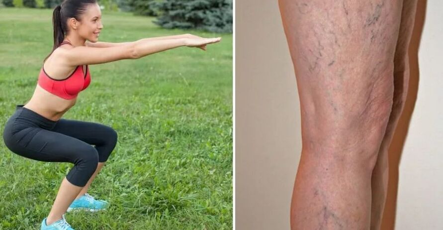 Varicocele legs