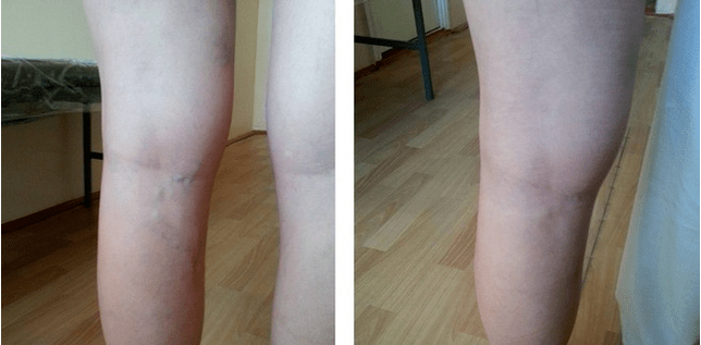 Veins on the legs